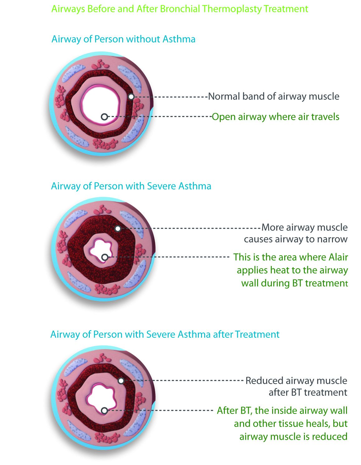 Various cross sections of airways, comparing those with asthma to those without.
