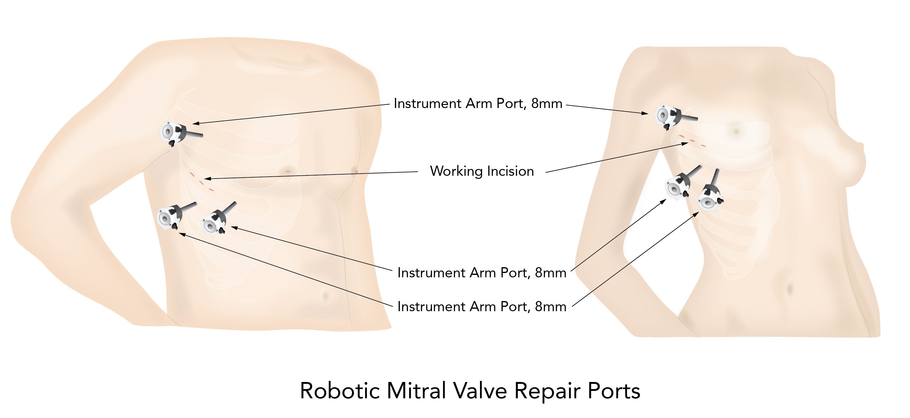 Robotic mitral valve repair and replacement, robotic heart surgery, minimally invasive surgery, stephanie mick, 